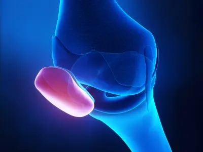 Patela do joelho dolorida Identificando as causas e medidas para aliviar a dor.