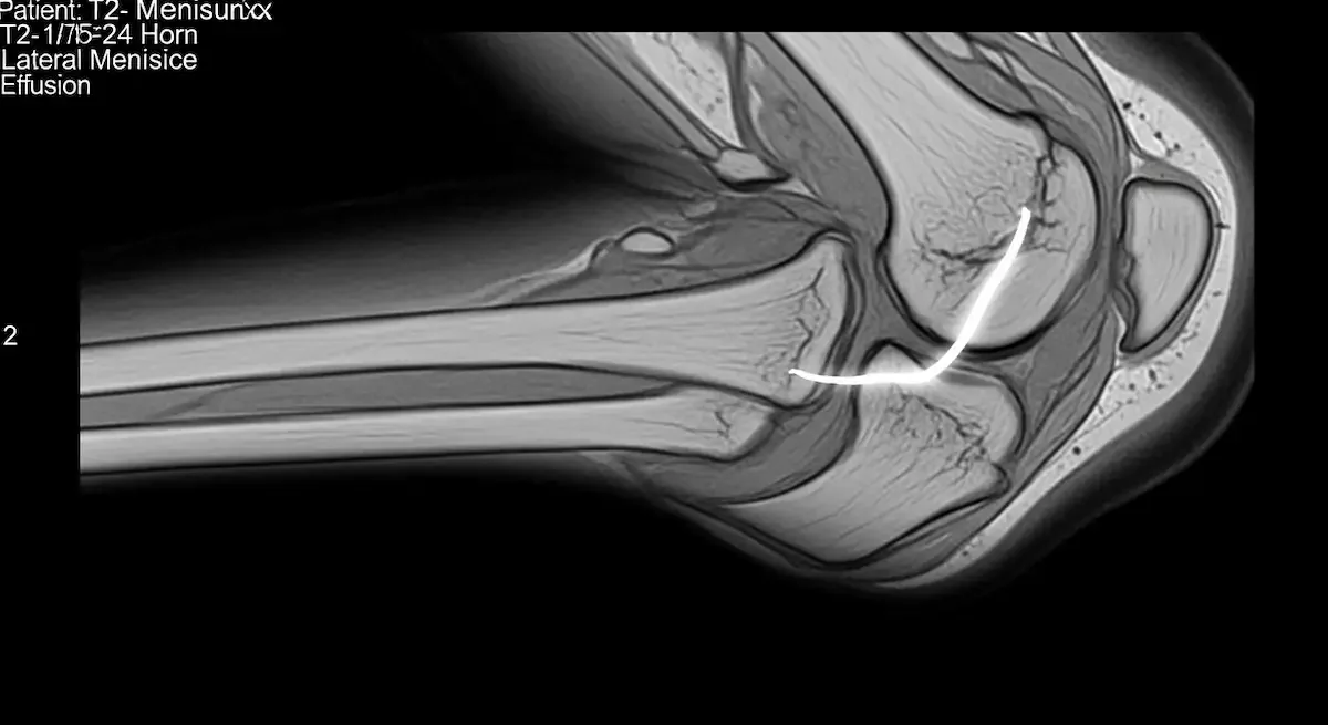 Meniscectomia parcial lateral