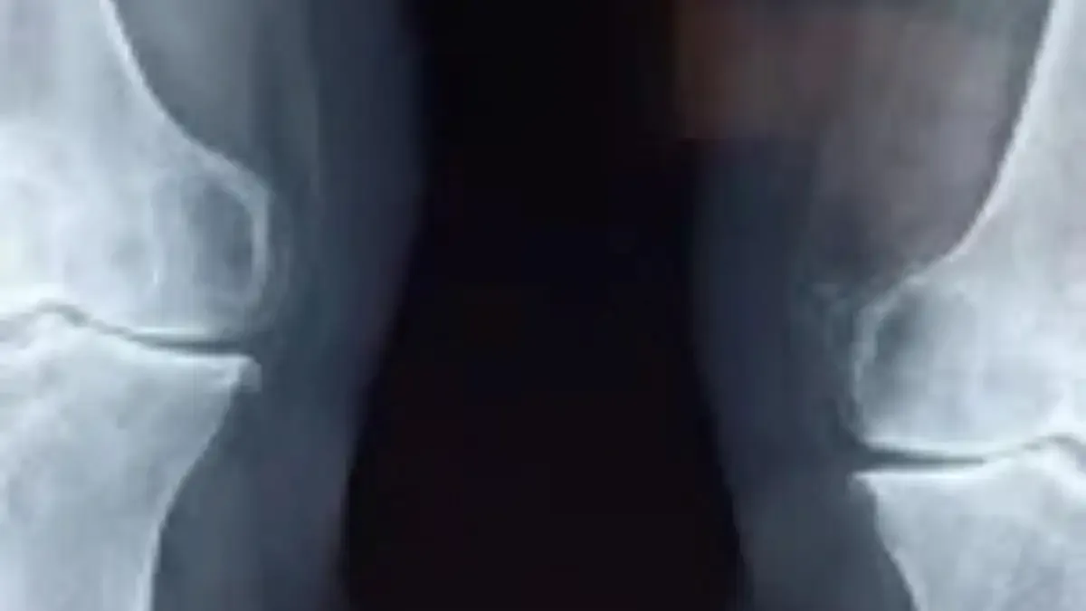 Redução do espaço articular femorotibial medial