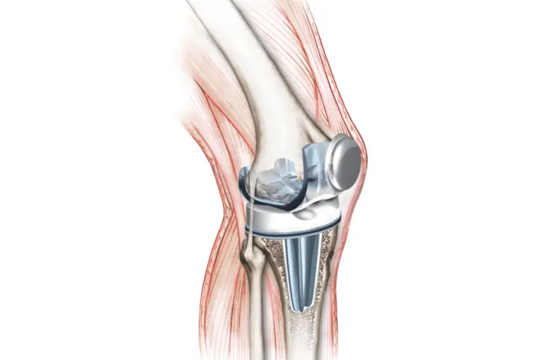 protese-total-joelho (4)